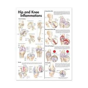  Hip and Knee Inflammations Anatomical Chart: Health 